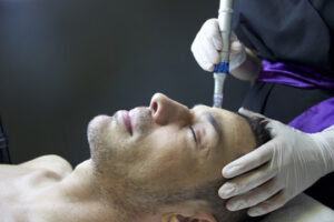 Microneedling