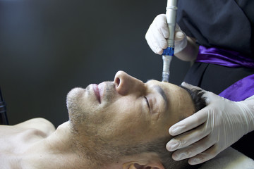 What Is Microneedling?